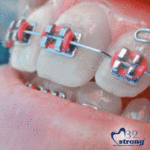 Gifs de aparelho dentário