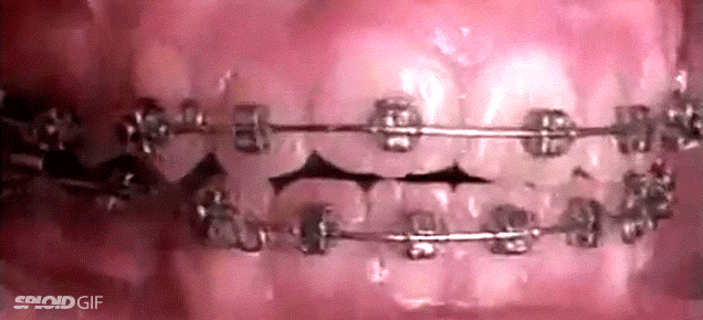 Gifs de aparelho dentário
